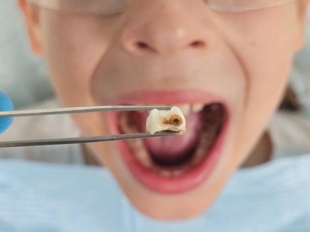 Best Emergency Wisdom Teeth Removal in North Boston, NY